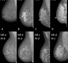 Selection of mammographic mediolateral oblique views of breasts with different breast density from women between 51 and 68 years of age. 