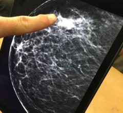 Researchers at Karolinska Institutet and Karolinska University Hospital in Sweden have compared the ability of three different artificial intelligence (AI) algorithms to identify breast cancer based on previously taken mammograms. The best algorithm proved to be as accurate as the average radiologist.