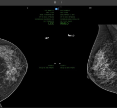 Image: Loading of 4 tomographic Mammography images on the OmegaAI cloud-native RIS/PACS platform in under one second using Progressive Loading. Megabit connectivity is illustrated on a standard browser and PC.