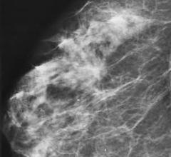 Managing Architectural Distortion on Mammography Based on MR Enhancement