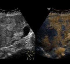 Contrast-enhanced ultrasound (CEUS) is more accurate and reliable than MRI for examining certain liver and kidney nodules 