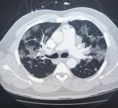 A lung CT of a COVID-19 patient, showing ground-glass opacities in the lung from COVID pneumonia. Image courtesy of John Kim.