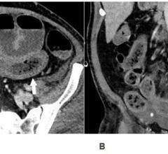 Axial (A) and coronal (B) CT of the abdomen and pelvis with IV contrast in a 57-year-old man with a high clinical suspicion for bowel ischemia. There was generalized small bowel distension and segmental thickening (arrows), with adjacent mesenteric congestion (thin arrow in B), and a small volume of ascites (* in B). Findings are nonspecific but suggestive of early ischemia or infection.