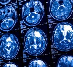 CT Scan brain GettyImages-2166623974