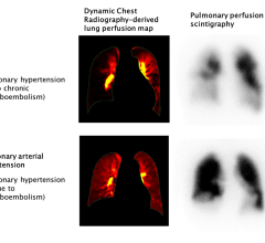Published online November 8 in the journal, Radiology, the study enabled the visualization of pulmonary hemodynamics and perfusion with high sensitivity, specificity and diagnostic accuracy, and without the use of contrast media 