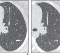 According to ARRS’ American Journal of Roentgenology (AJR), reduced-dose CT depicts greater than 90% of lung nodules in children and young adults with cancer, identifying the presence of nodules with moderate sensitivity and high specificity.