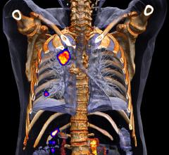 CT systems, computed tomography, lung cancer, study, screening, Europe