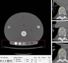 The Mindways Solid phantom with volume of interest in the quality assurance phantom (red circles, left side). A participant's noncontrast-enhanced axial CT (right side) with volume of interest (yellow circles) in the trabecular bone compartment of three vertebrae for bone mineral density measurements. Image courtesy of Radiological Society of North America