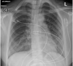 Chest X-ray image of patient with lung injury due to vaping. Image courtesy of UC Regents #COVID19 #pandemic