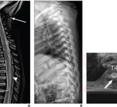 According to an article in ARRS’ American Journal of Roentgenology (AJR), whole-spine MRI commonly demonstrates isolated thoracolumbar injuries in children with suspected abusive head trauma. #childabuse #pediatricimaging