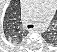 #COVID19 #Coronavirus #2019nCoV #Wuhanvirus #SARScov2 Chest CT findings of pediatric patients with COVID-19 on transaxial images. (a) Male, 2 months old, 2 days after symptom onset. Patchy ground-glass opacities GGO in the right lower lobe