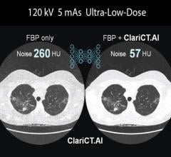 ClariPi Gets FDA Clearance for AI-powered CT Image Denoising Solution