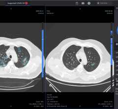 #COVID19 #Coronavirus #2019nCoV #Wuhanvirus #SARScov2 The Chinese start-up company Infervision launches its AI-based solution InferRead CT Lung Covid-19 also in Europe 