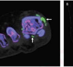 83-Year-Old Woman With No History of Gout and Serum Uric Level of 9.2 mg/dl, Who Underwent DECT (2013) of Right Foot Due to Right Ankle Pain and Swelling: (A) Coronal image through forefoot and (B) coronal image through ankle. Green pixels (arrows) observed in association with first and fourth metatarsophalangeal joints (A) and tibiotalar joint (B), consistent with monosodium urate deposition. Examination interpreted as positive for gout. Final clinical diagnosis by referring service was gout. Confirmatory 
