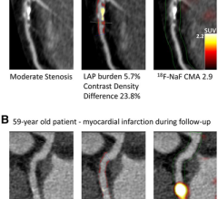 Case examples of quantitative plaque analysis on coronary CT angiography and 18F-NaF PET in patients with established coronary artery disease. Hybrid CT angiography and 18F-NaF PET of coronary arteries. (A) A 70-y-old male, who presented with diffused largely noncalcified disease (middle panel in red) in the LAD and demonstrated increased 18F-NaF uptake in the LAD on PET. (B) A 59-y-old male with mild LCX atherosclerosis, who presented with a high noncalcified plaque burden (middle panel in red) on CT angio