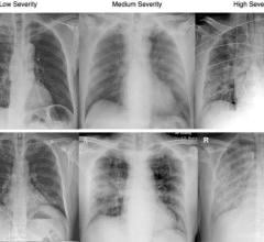 Chest X-rays used in the COVID-Net study show differing infection extent and opacity in the lungs of COVID-19 patients. Image courtesy of University of Waterloo