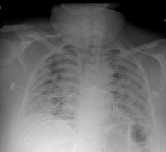 Chest X-ray from patient severely ill from COVID-19, showing (in white patches) infected tissue spread across the lungs. Image courtesy of Nature Publishing or npj Digital Medicine