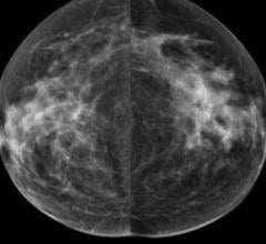 Artificial Intelligence Used in Clinical Practice to Measure Breast Density