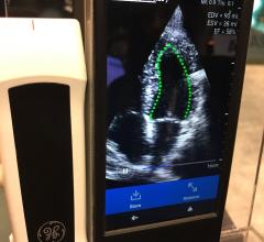 An example of DiA'a automated ejection fraction AI software on the GE vScan POCUS system at RSNA 2019.