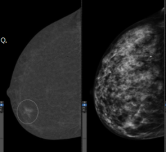 Left: Recombined image of the CEM exam showing iodine uptake. Right: Standard digital mammogram. 