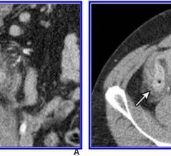 IV contrast-enhanced 2-mSv 4-mm-thick transverse and coronal (b) CT images show inflamed diverticula (arrows), segmental colonic wall thickening, and adjacent pericolic fat stranding. Image courtesy of the American Roentgen Ray Society (ARRS), American Journal of Roentgenology (AJR)