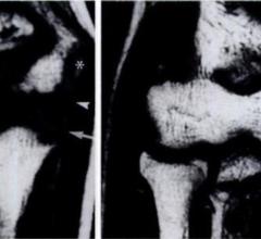 Elbow images. In image on the left (10-year-old boy), growth plate has not yet fused. On the right (15-year-old boy), growth plate has fused. (Courtesy of Radiology)