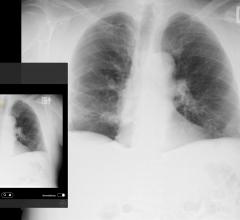  Emergent Connect pneumothorax image