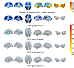 F-18 FDG PET in COVID-19–related CNS disorders: Principal components analysis of spatial covariance pattern (first row) and statistical parametric mapping analysis of metabolic group differences (second to fifth rows) in patients with COVID-19–related encephalopathy, patients with post-COVID-19 syndrome, and patients with post-COVID-19 syndrome and hyposmia compared to healthy controls (n=13). Image Created by PT Meyer, S Hellwig, G Blazhenets and JA Hosp, Medical Center – University of Freiburg, Germany.