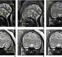33-year-old patient (gestational age, 30 weeks and 6 days), without in utero opioid exposure, who underwent fetal MRI 
