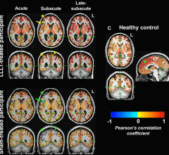 Functional MRI brain maps of resting-state functional connectivity in representative age- and sex-matched participants