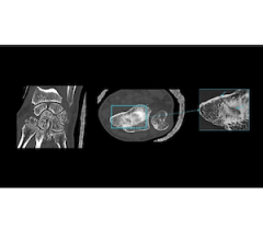 deep learning, CT, GE HealthCare