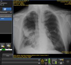 #RSNA19 A sophisticated type of artificial intelligence (AI) can detect clinically meaningful chest X-ray findings as effectively as experienced radiologists, according to a study published in the journal Radiology.