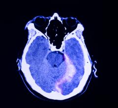 UCSF-led study matches brain imaging with prognosis, showing lingering impairment for some