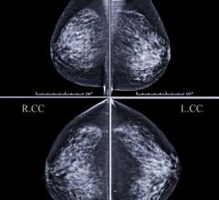 The Breast Imaging and Reporting System (BI-RADS) was established by the American College of Radiology to help classify findings on mammography. Findings are classified based on the risk of breast cancer, with a BI-RADS 2 lesion being benign, or not cancerous, and BI-RADS 6 representing a lesion that is biopsy-proven to be malignant.