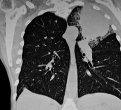 Swiftness is essential when treating lung cancer, the second most common type of cancer in the U.S. and the country's leading cause of cancer deaths. 