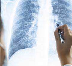  Disease of the small airways in the lungs is a potential long-lasting effect of COVID-19, according to a new study published in the journal Radiology. 