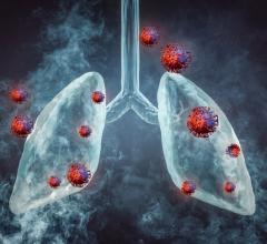 Nearly one quarter of deaths from lung cancer could be avoided in high-risk populations through the adoption of targeted screening with low-dose computed tomography (LDCT) scans, as based on the results of the NELSON study.