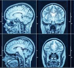 A new Yale-led study shows that a portable magnetic resonance imaging (MRI) device can help identify such intracranial hemorrhages, potentially life-saving information particularly in areas or scenarios where access to sophisticated brain imaging scans are not readily available.
