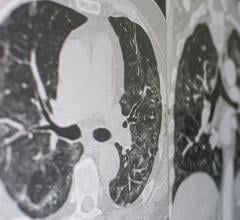 Perspective on management of LDCT findings on low-dose computed tomography examinations for lung cancer screening