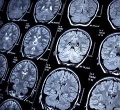 Researchers from the School of Biomedical Engineering & Imaging Sciences at King's College London have automated brain MRI image labeling, needed to teach machine learning image recognition models, by deriving important labels from radiology reports and accurately assigning them to the corresponding MRI examinations
