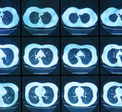 The American College of Radiology (ACR) is calling on radiologists nationally to respond to a solicitation for public comment from the Centers for Medicare and Medicaid Services (CMS) about lung cancer screening with low dose computed tomography (LDCT).