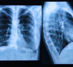 Revised guidelines for lung cancer screening eligibility are perpetuating disparities for racial/ethnic minorities, according to a new study in Radiology.