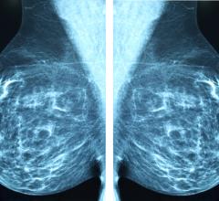 Researchers said women who skip even one scheduled mammography screening before a breast cancer diagnosis face a significantly higher risk of dying from the cancer.