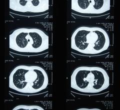 Artificial intelligence can categorize cancer risk of lung nodules