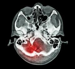 A new study published in JAMA Neurology suggests that certain features that appear on computed tomography (CT) scans help predict outcomes following mild traumatic brain injury (TBI)