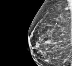 A targeted intervention providing mammograms to hospitalized Medicaid patients can help patients complete overdue breast cancer screening