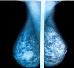 3-D mammography reduces the number of breast cancer cases diagnosed in the period between routine screenings, when compared with traditional mammography, according to a large study from Lund University in Sweden. The results are published in the journal Radiology.