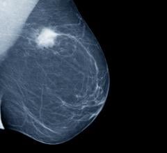 Breast cancer screening has been shown to reduce cancer fatalities. AI tools have the potential to make screening more efficient and effective. 