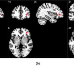 Figure 1. Group analysis on susceptibility-weighted imaging exhibiting higher susceptibility-weighted imaging values in the COVID group when compared to healthy controls. Three significant clusters were found primarily in the white matter regions of the pre-frontal cortex and in the brainstem. The clusters (a) and (b) are observed bilaterally in the cerebral white matter near the orbitofrontal gyrus, whereas (c) lies in the midbrain region.