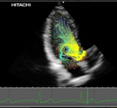 Hitachi Medical Systems Europe Introduces Third-Generation Intelligent Vector Flow Mapping
